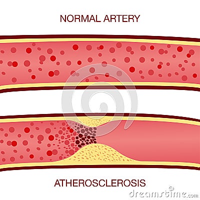 Cholesterol plaque in artery atherosclerosis illustration Vector Illustration