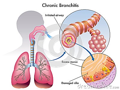 Chronic bronchitis Vector Illustration