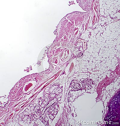 Chronic bronchitis, light micrograph Stock Photo