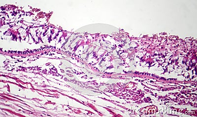 Chronic bronchitis, light micrograph Stock Photo