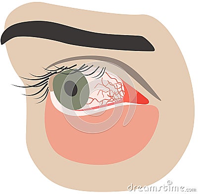 Chronic conjunctivitis eye with a red iris Vector Illustration