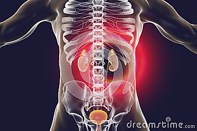 Chronic glomerulonephritis, gross pathology Cartoon Illustration