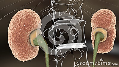 Chronic glomerulonephritis, gross pathology Cartoon Illustration