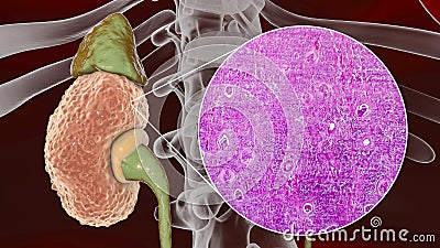 Chronic glomerulonephritis, gross pathology Cartoon Illustration