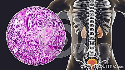 Chronic glomerulonephritis, gross pathology Cartoon Illustration