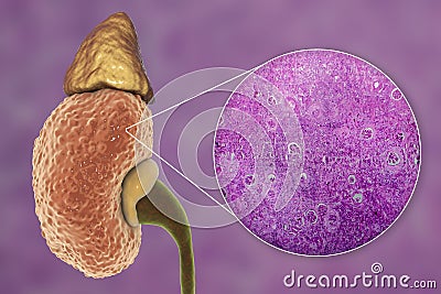 Chronic glomerulonephritis, gross pathology Cartoon Illustration