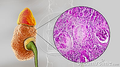 Chronic glomerulonephritis, gross pathology Cartoon Illustration