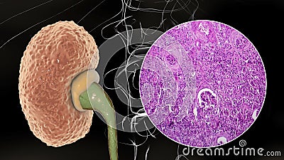 Chronic glomerulonephritis, gross pathology Cartoon Illustration