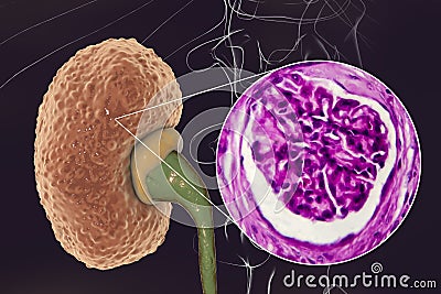 Chronic glomerulonephritis, gross pathology Cartoon Illustration