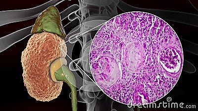 Chronic glomerulonephritis, gross pathology Cartoon Illustration