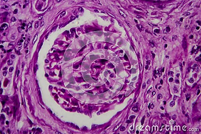 Chronic glomerulonephritis, light micrograph Stock Photo