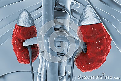 Chronic kidney disease Cartoon Illustration