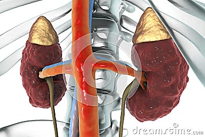 Chronic kidney disease Cartoon Illustration