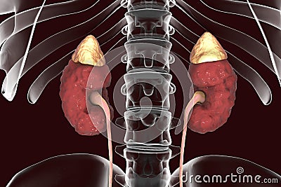 Chronic kidney disease Cartoon Illustration