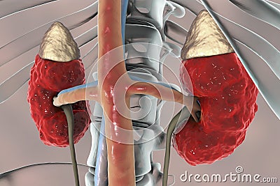 Chronic kidney disease Cartoon Illustration