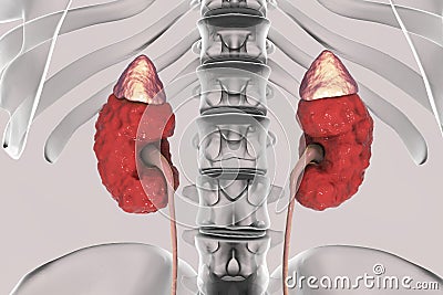 Chronic kidney disease Cartoon Illustration