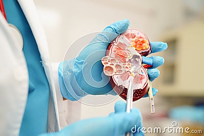 Chronic kidney disease, doctor holding model for treatment urinary system, urology, Estimated glomerular filtration rate eGFR Stock Photo