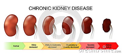Chronic kidney disease. Stage of disorder Vector Illustration