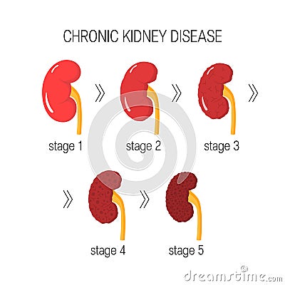 Chronic kidney disease vector Vector Illustration