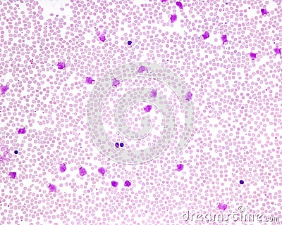 Blood smear. Chronic lymphocytic leukemia Stock Photo