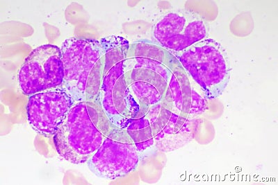 Chronic myeloid leukemia cells or CML Stock Photo