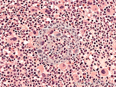 Chronic myeloid leukemia, bone marrow. Stock Photo