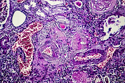 Chronic nephritis, light micrograph Stock Photo