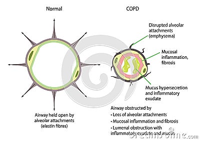Chronic obstructive pulmonary disease Vector Illustration
