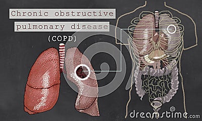 Chronic Obstructive Pulmonary Disease with Lungs Stock Photo