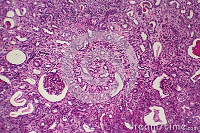 Chronic pyelonephritis, light micrograph Stock Photo