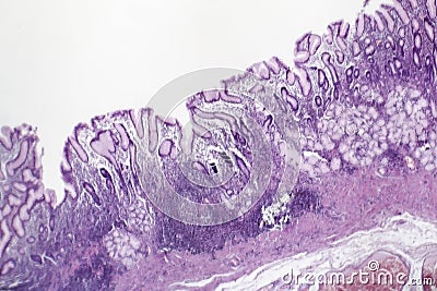 Chronic superficial gastritis, light micrograph Stock Photo