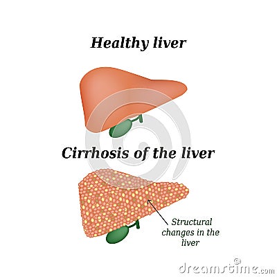Cirrhosis of the liver. Vector illustration on background Vector Illustration