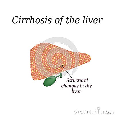 Cirrhosis of the liver. Vector illustration on background Vector Illustration