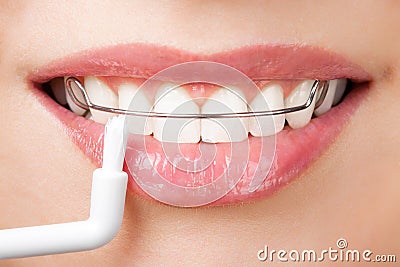 Cleaning teeth with retainer Stock Photo