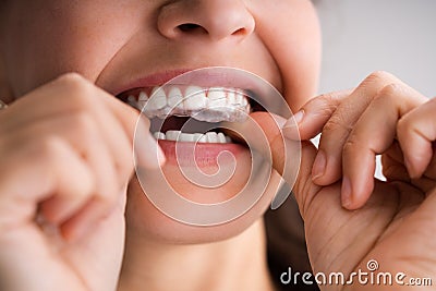 Clear Aligner Dental Night Guard Stock Photo