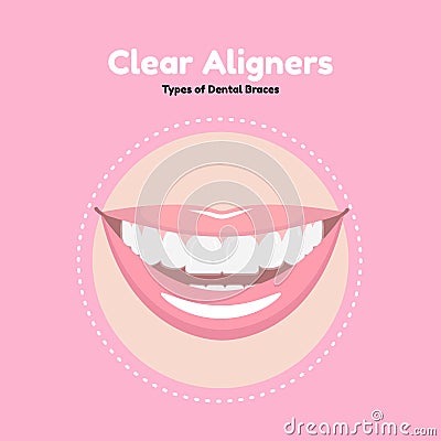 Clear Dental Alighers. Vector Illustration