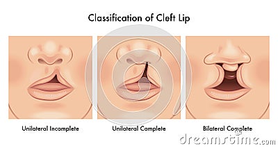 Cleft lip medical illustration Vector Illustration