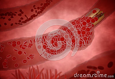 Clogged Artery with platelets and cholesterol plaque, concept for health risk for obesity or dieting and nutrition problems Stock Photo