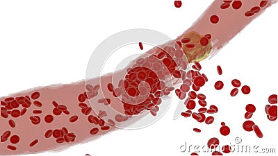 Clogged Artery with platelets and cholesterol plaque, concept for health risk for obesity Stock Photo