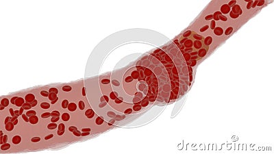 Clogged Artery with platelets and cholesterol plaque, concept for health risk for obesity Stock Photo