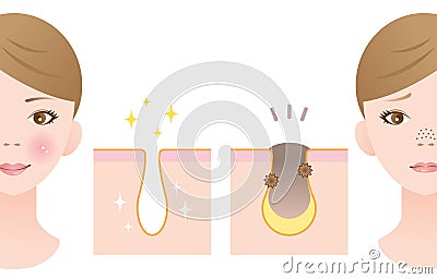 Female face in profile before and after unclogging pore treatment Vector Illustration