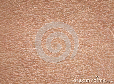 close human skin with dermatological problems of dryness Stock Photo