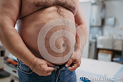 Close up of abdomen of overweight patient. High waist circumference of obese man, belly fat. Concept of health risks of Stock Photo