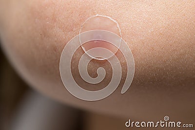 acne or pimple patch on woman skin Stock Photo