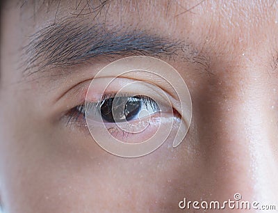 Close up of Asian young man with brown eye with stye infection. Eyelid abscess, hordeolum in medical health, disease and treatment Stock Photo