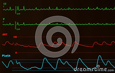 Close Up of Atrial Flutter on Monitor with Black Screen Stock Photo