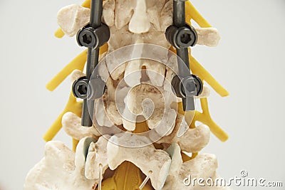 Model of instrument fixation of human lumbar spine model Stock Photo