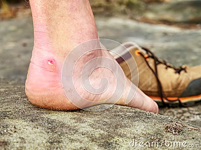 Close up on Blister on foot of a male. Hurt hikers legs without shoes. Stock Photo