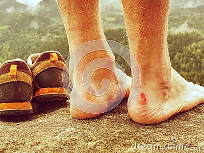 Close up on Blister on foot of a male. Hurt hikers legs without shoes Stock Photo