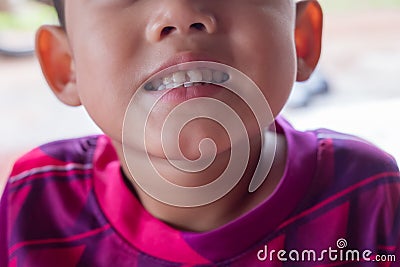 Close up boy smiling tooth caries. the concept of dental and oral health of children and toothpaste Stock Photo